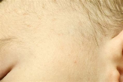 Allergic Reaction Heat Rash On Babys Scalp Identify Baby Eczema