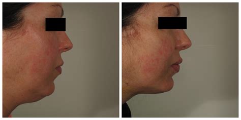 Chin Lipo Before And After 1 Laser Lipo