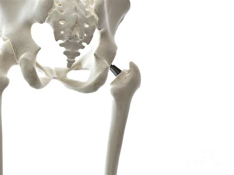 Illustration Of A Hip Replacement Photograph By Sebastian Kaulitzki