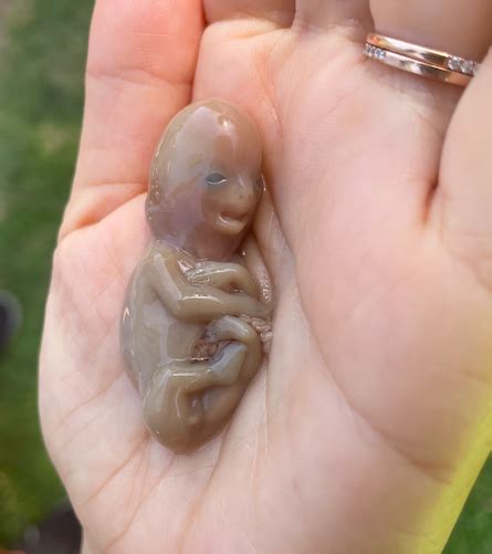 Miscarried Embryo At 2 Weeks