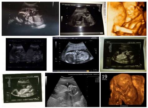 Semana 19 De Embarazo Síntomas Desarrollo Fetal Panza Y Ecografía