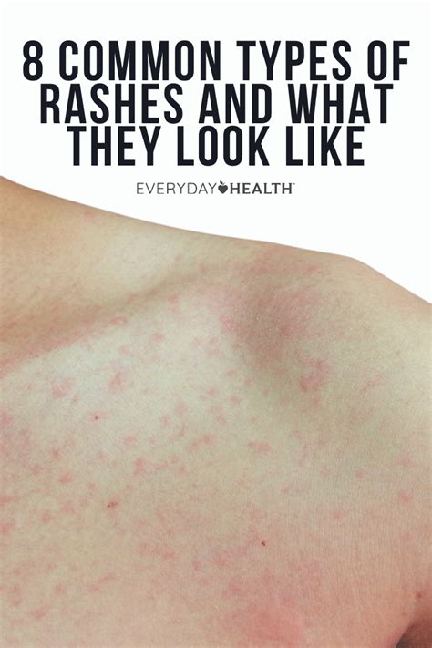 Common Types Of Rashes And What They Look Like In Rashes Heat Images And Photos Finder