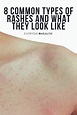 8 Common Types of Rashes and What They Look Like in 2021 | Rashes, Heat ...