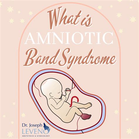 What Is Amniotic Band Syndrome Dr Joseph Leveno