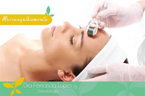 Dra Fernanda Lopes Dermatologia Blog Microagulhamento