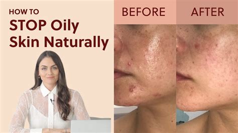 How To Stop Oily Skin Naturally 4 Proven Tips Youtube