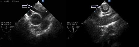 A Transesophageal Echocardiography Demonstrating Pulmonary Artery