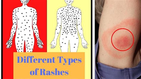 Different Types Of Rashes Youtube
