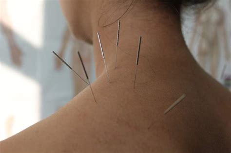 Akupunktur Schmerzlinderung Und Heilung Durch Nadelstiche