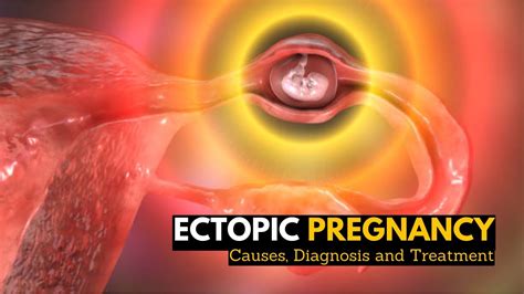 Ectopic Pregnancy Causes Signs And Symptoms Diagnosis And Treatment