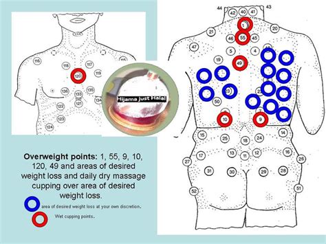 Cupping Points Diagram