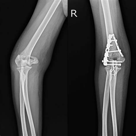 Distal Humerus Fracture Fixation Elbow Surgeon South Windsor