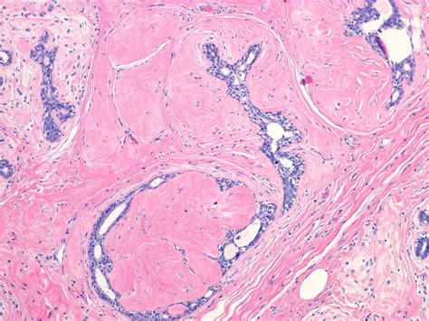 Pathology Outlines Fibroadenomatoid Change