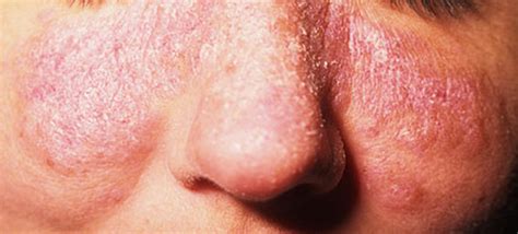 Lupus Rashes Types Causes Symptoms Diagnosis And Medical Treatments