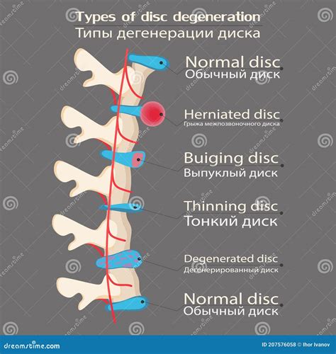 Spinal Disc Degeneration Illustration Educational Medical Illustration