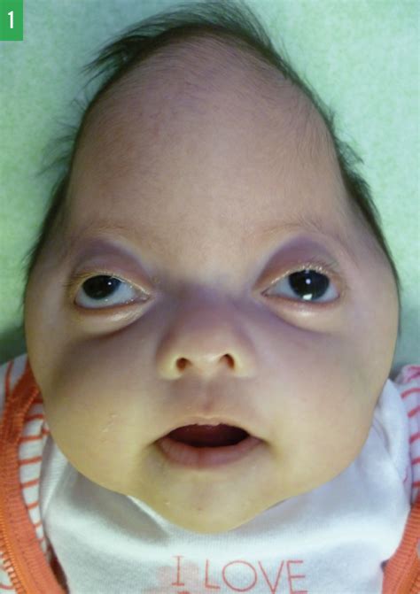 Pfeiffer Syndrome Type 2 Cloverleaf Shaped Skull In A Newborn