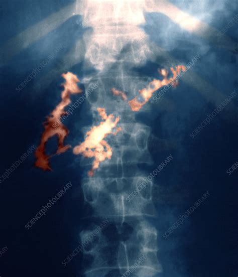 Inflamed Pancreas X Ray Stock Image M2400408 Science Photo Library