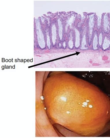 Finding And Managing Sessile Serrated Polyps Can Be Challenging