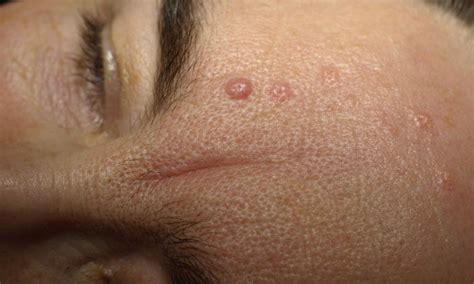 Sebaceous Glands Bumps