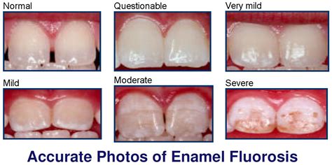 Enamel Hypomineralization Treatment Bauer Smiles