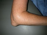 Elbow (Olecranon) Bursitis - OrthoInfo - AAOS