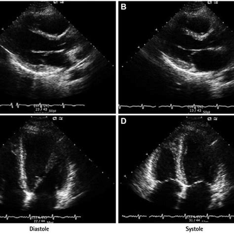 Transthoracic Echocardiography At The Time Of Pulmonary Embolism Shows