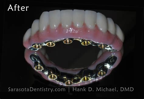 What Are Flexible Partial Dentures Sarasota Dentistry