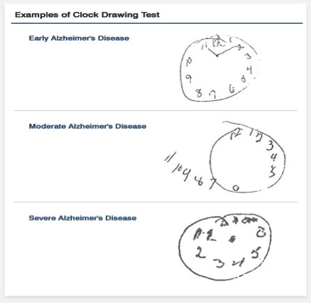 Moca scoring nuances with clock draw : Tests of cognitive skills that can flag older drivers who ...