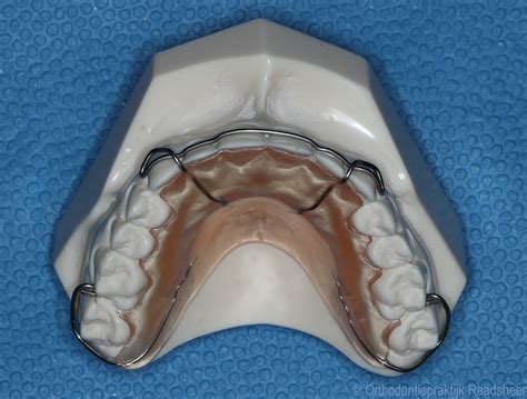 Na De Orthodontische Behandeling Orthodontiepraktijk Raadsheer