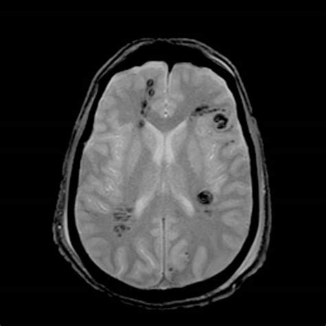 The prognostic value of lesion load in corpus callosum, brain stem, and thalamus in different magnetic resonance imaging sequences. Diffuse axonal injury - wikidoc