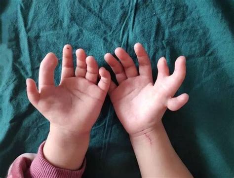 girl born with too many fingers has extra digits surgically removed ladbible