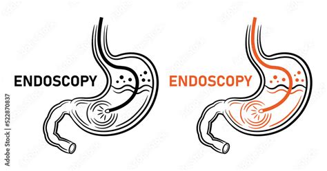 Endoscopy Stomach Endoscope Gastroscopy Gastrointestinal Medical