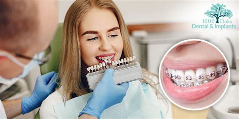 Veneers Vs Braces Which Is Right For You 1000oaks Dental
