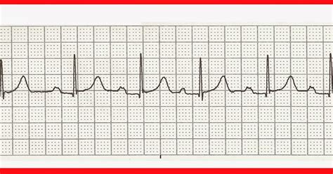 Quickly memorize the terms, phrases and much more. Float Nurse: Practice EKG Rhythm Strips 232