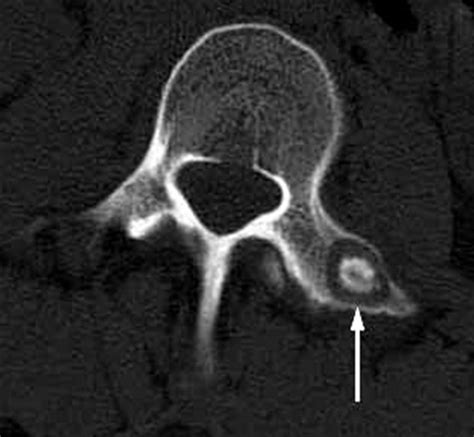 Osteoid Osteoma Spine Mri