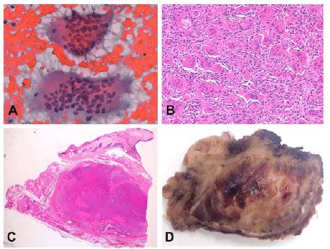 Multinucleated Giant Cells A Osteoclastic Type Giant Cells Separated