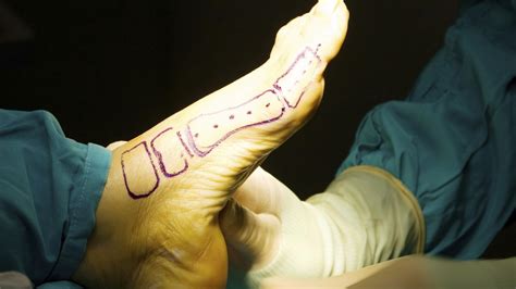 Foot And Ankle Gallery Orthopaedic Surgery Michigan Medicine University Of Michigan