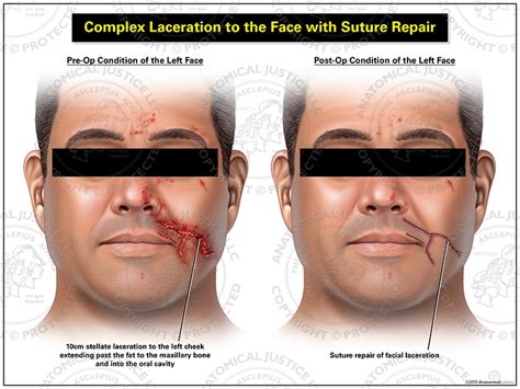 Complex Facial Laceration With Suture Repair