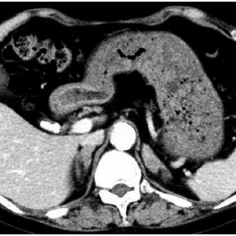 Abdominal Contrast Enhanced Computed Tomography Ct The Image