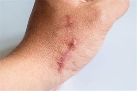 Keloid And Hypertrophic Scarring Laser Skin Care