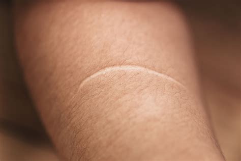 Scar On Human Skin Keloid On Stock Photo Edit Now My XXX Hot Girl