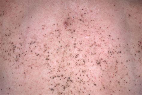 Derm Dx A 32 Year Old Man With Multiple Itchy Malodorous