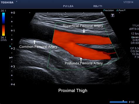 Peripheral Arterial Ultrasound Evaluations