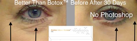 Better Than Botox™ Imagine Laserworks