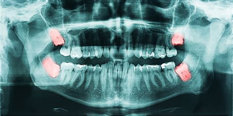 Wisdom Teeth 5 Reasons They Should Go Greenspoint Dental Houston