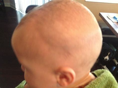 Weird Fluid Filled Bump On Head Babycenter