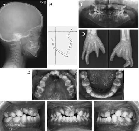 Images Of Case 1 A Cephalogram B Profilogram C Panoramic