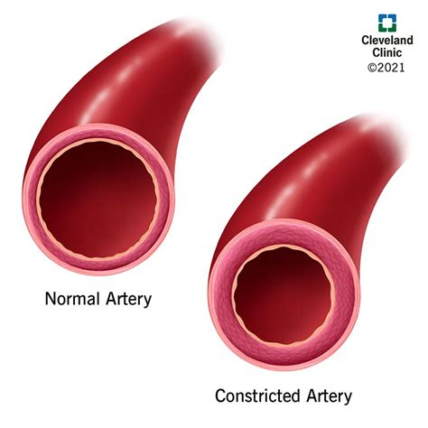Constricted Artery Arteria Estrecha Enallterm