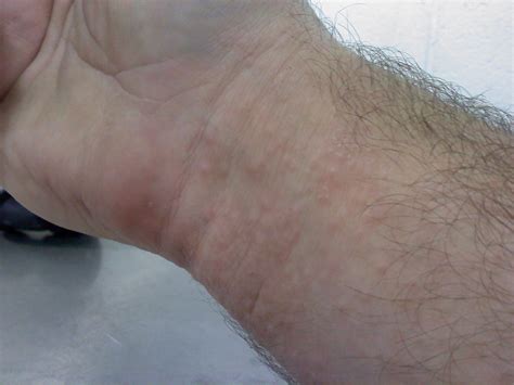 Rashes On Hands And Wrists Pictures Photos