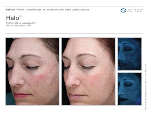 Halo™ Laser Treatments In Monroe For Skin Resurfacing
